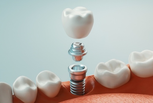 Animated smile during dental implant supported dental crown placement