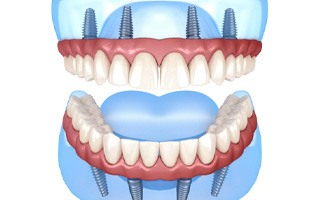 a closeup of implant dentures 