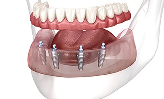 a graphic render of implant-retained dentures