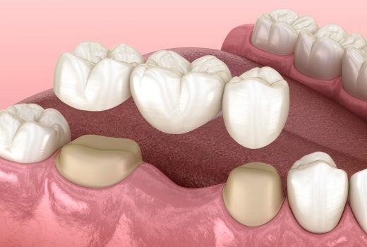 Animated smile during fixed bridge placement