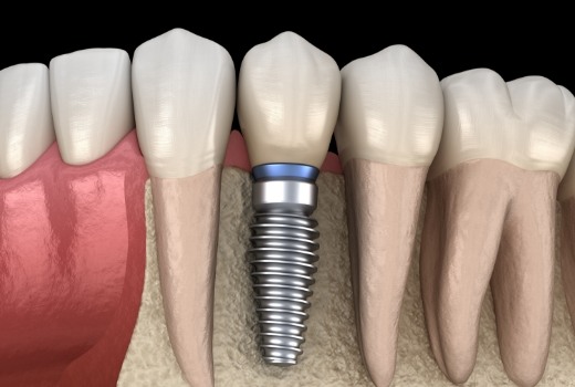 Animated smile with dental implant supported dental crown