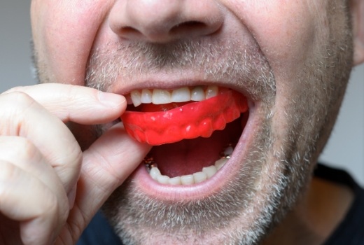 Closeup of dental patient placing sportsguard