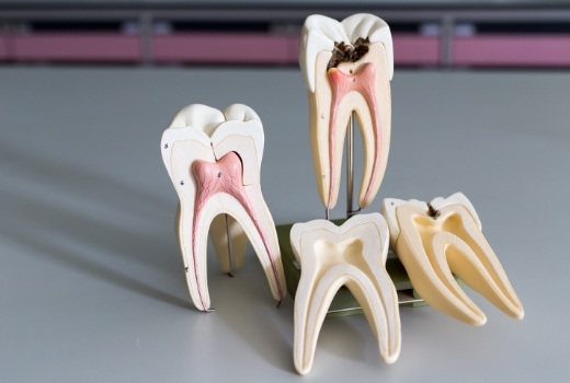 Model smile showing healthy tooth compared with tooth in need of root canal treatment