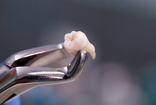 Metal clasp holding tooth after extraction