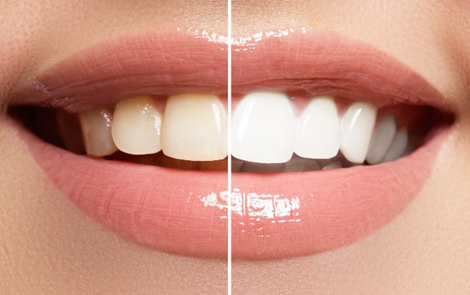 Before and after teeth whitening treatment